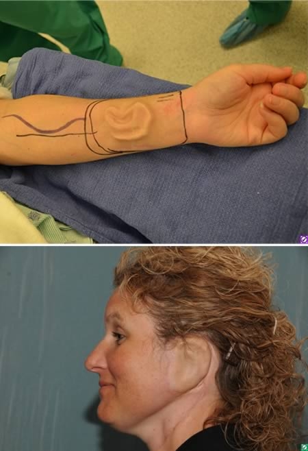 The woman who grew an ear on her arm