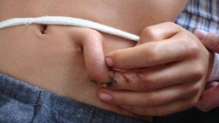 The man who grew a fingertip on his stomach