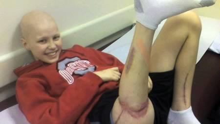 The teenage boy with cancer who had his leg detached and turned 180 degrees in order to play again