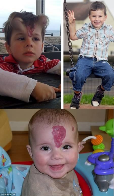 The little boy who was given ‘devil's horns' implants to remove birth mark
