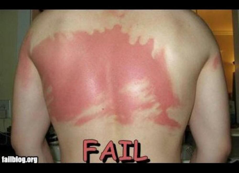 FAIL!!! Sun burns