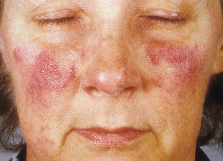 If you're dealing with rosacea as is, alcohol brings it out even more. 