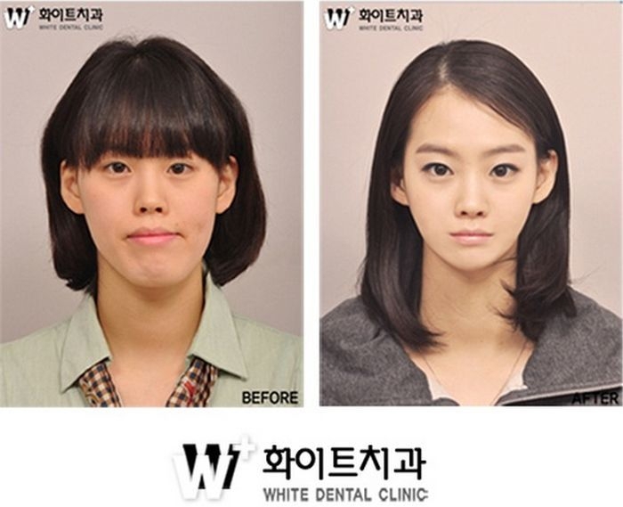 Before and After Plastic Surgery