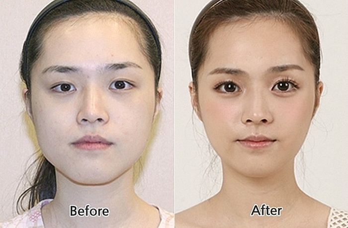 Before and After Plastic Surgery