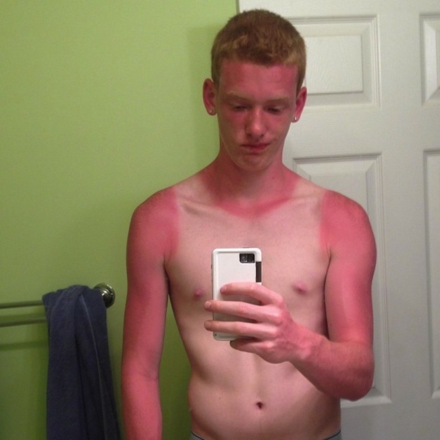 11 Painful Sunburns We Never Want to Experience