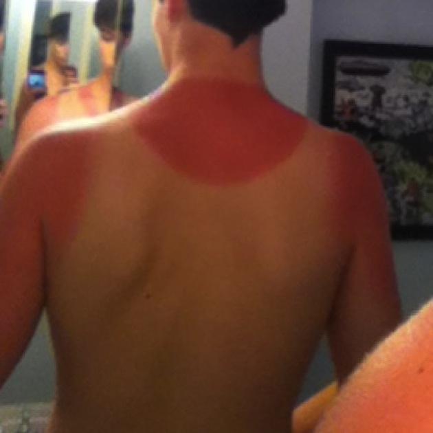11 Painful Sunburns We Never Want to Experience