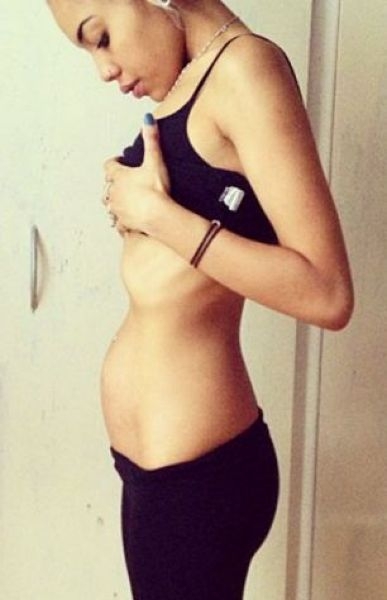 The Anorexic Pregnant Girl 