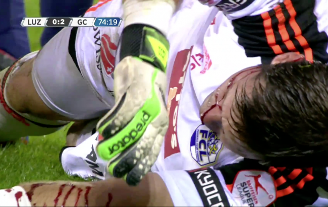 A Soccer Goalie Got His Face Removed By An Opposing Player's Cleats