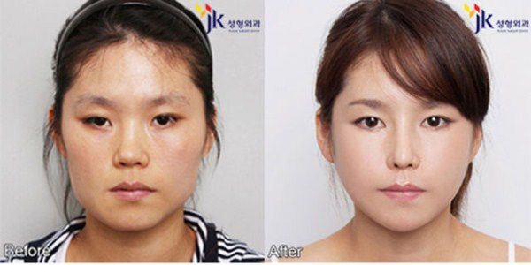 Plastic surgery in South Korea: before and after