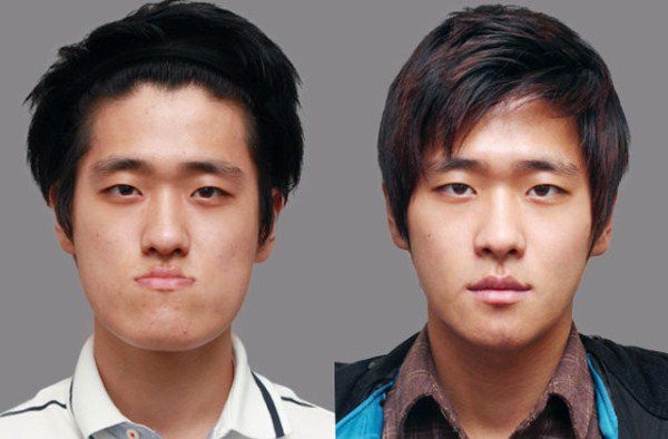 Plastic surgery in South Korea: before and after