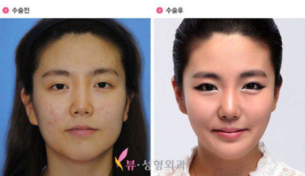 Plastic surgery in South Korea: before and after