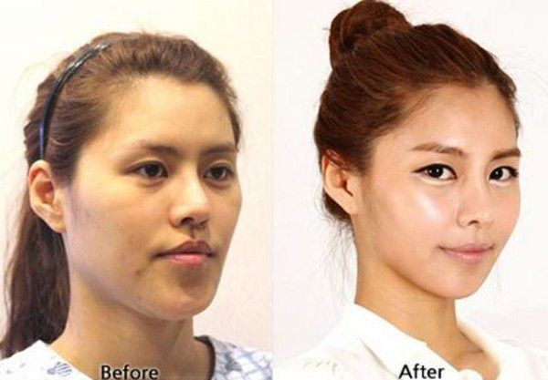 Plastic surgery in South Korea: before and after