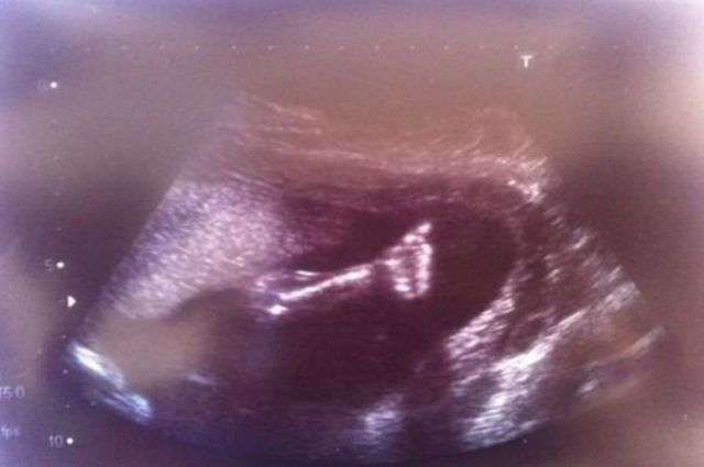 UK's youngest heart op baby