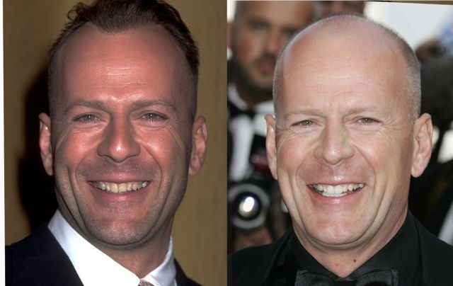 Celebs with and without hair is no subtle difference