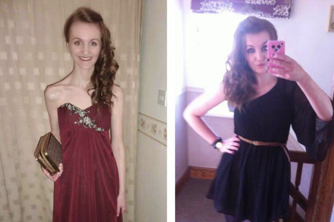 Positive Before and After Pics of Eating Disorder Sufferers