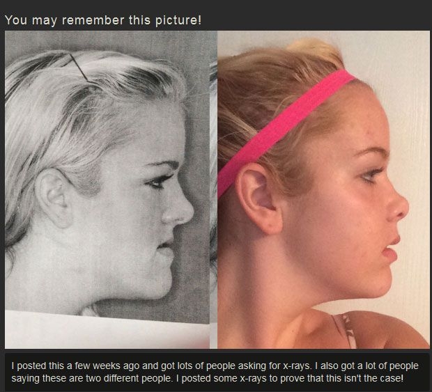 Before And After Jaw Surgery