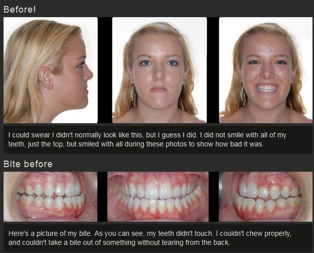 Before And After Jaw Surgery