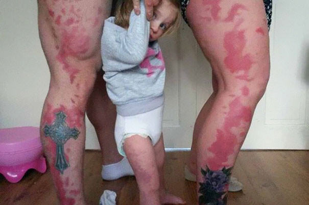 Parents Tattoo Their Legs With Daughter’s Birthmark