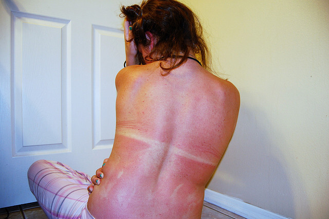 20 People Doomed To Spend The Summer With Awkward Tans