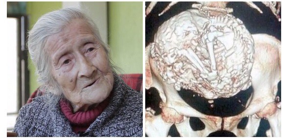 A Woman Has Been Pregnant With A Calcified Fetus For Over 60 Years