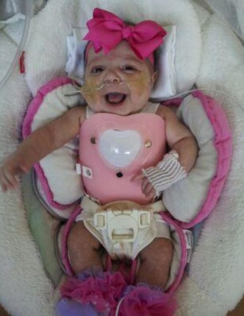 Here's How This Girl Born With Her Heart Outside Her Chest Managed To Survive