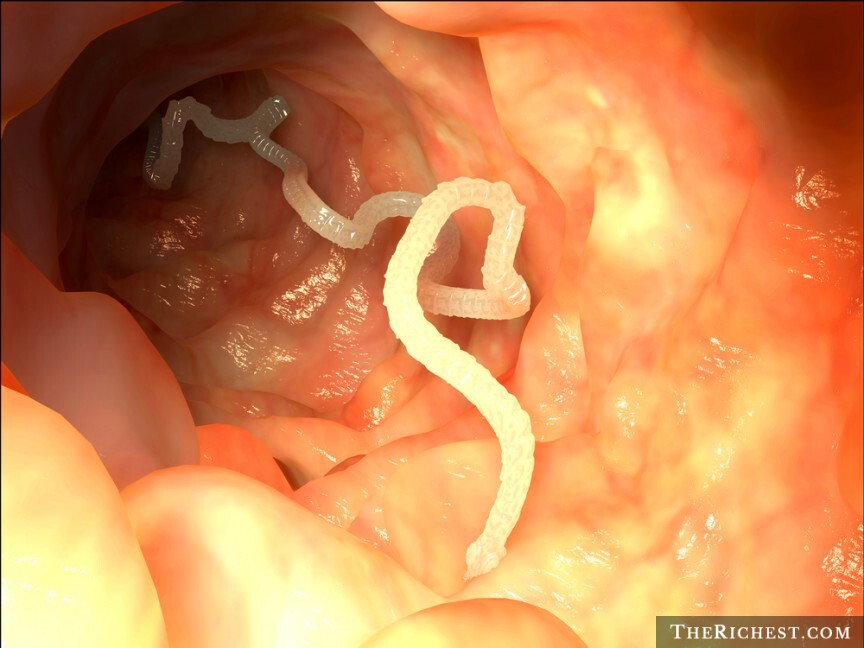 5. Tapeworms In The Intestines