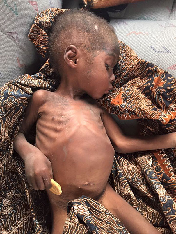 Hope was suffering from malnutrition and worms