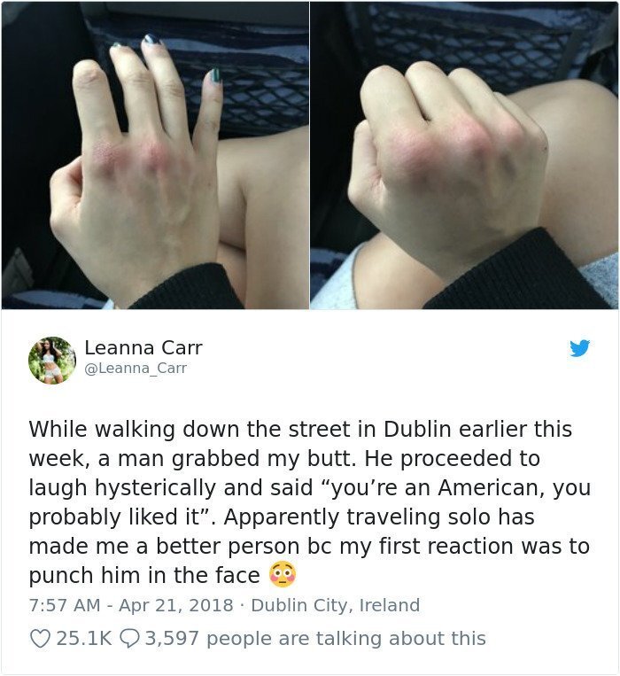 On April 21st, she uploaded a picture of her swollen knuckles on Twitter telling about her experience in Irish capital