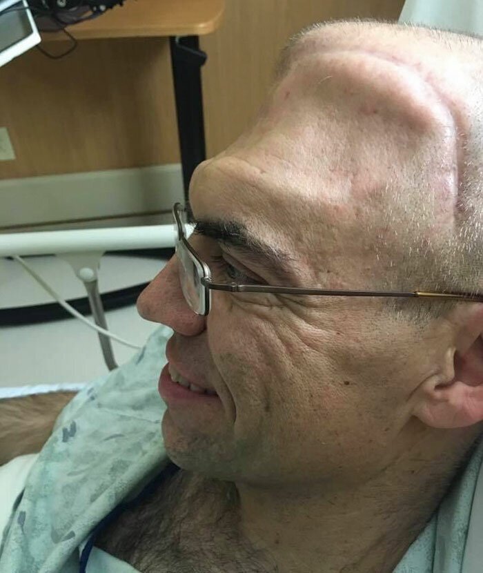 Guy Who Was Supposed To Live For 6 Years After Brain Cancer Diagnosis, Lives For 20+ Years