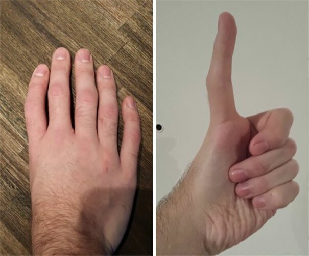 #20 Five Fingers, No Thumb