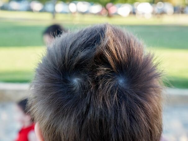 #7 My Son Has Symmetrical Hair Whorls Which Go In Opposite Directions. This Allows Him To Grow A Natural Mohawk