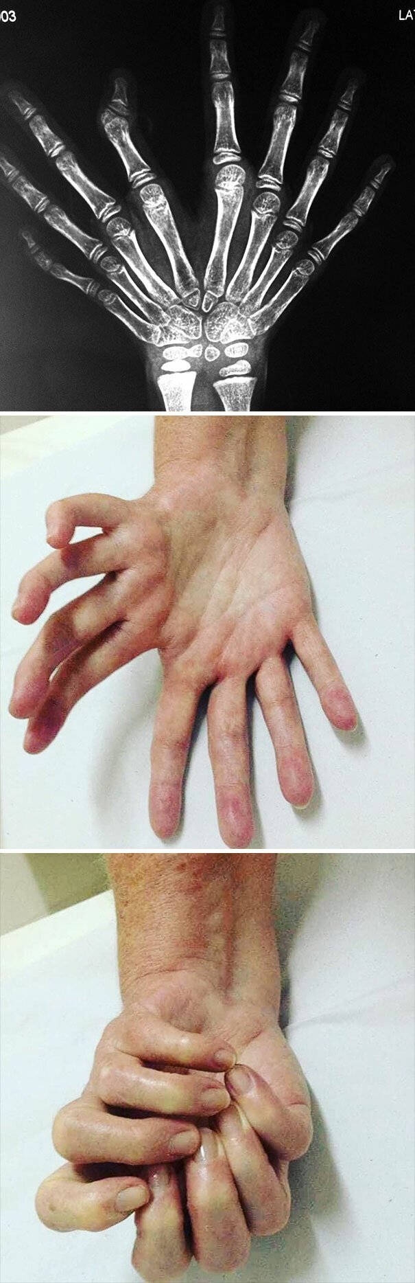#12 Ulnar Dimelia Or Mirror Hand Syndrome
