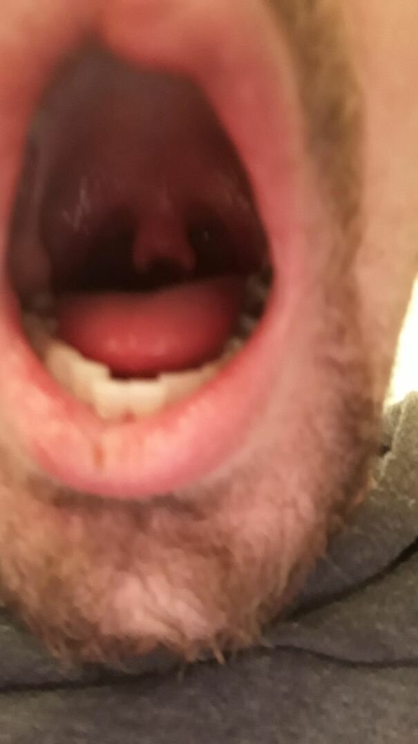 #40 Have A Look At My Bifurcated Uvula