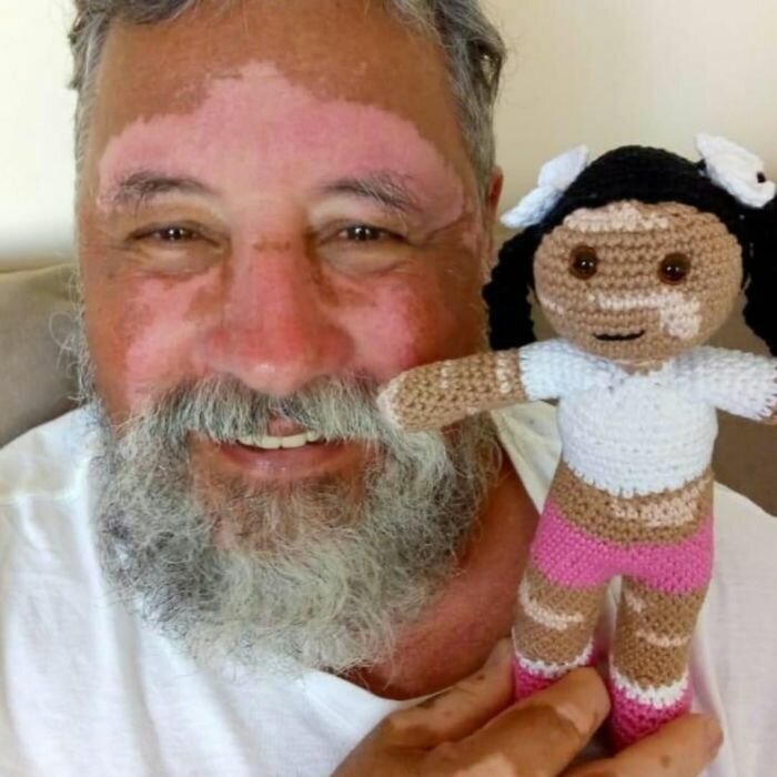 Grandpa With Vitiligo Crochets Dolls To Encourage Kids Who Suffer From This Condition