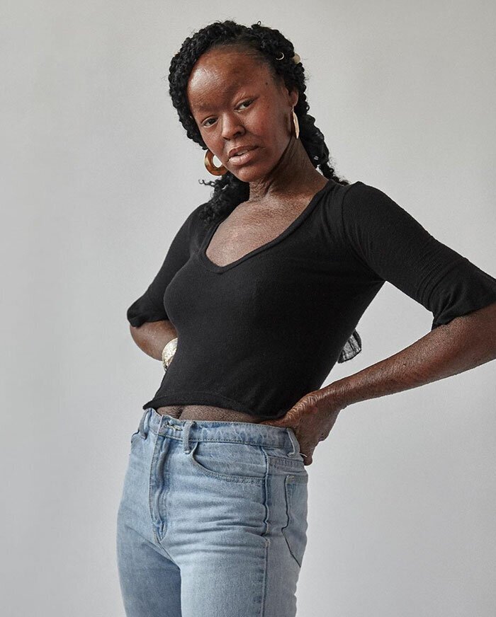 This Woman Never Saw Models With Her Skin Condition, So She Became One