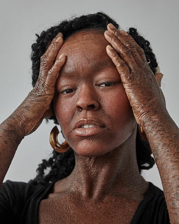 This Woman Never Saw Models With Her Skin Condition, So She Became One
