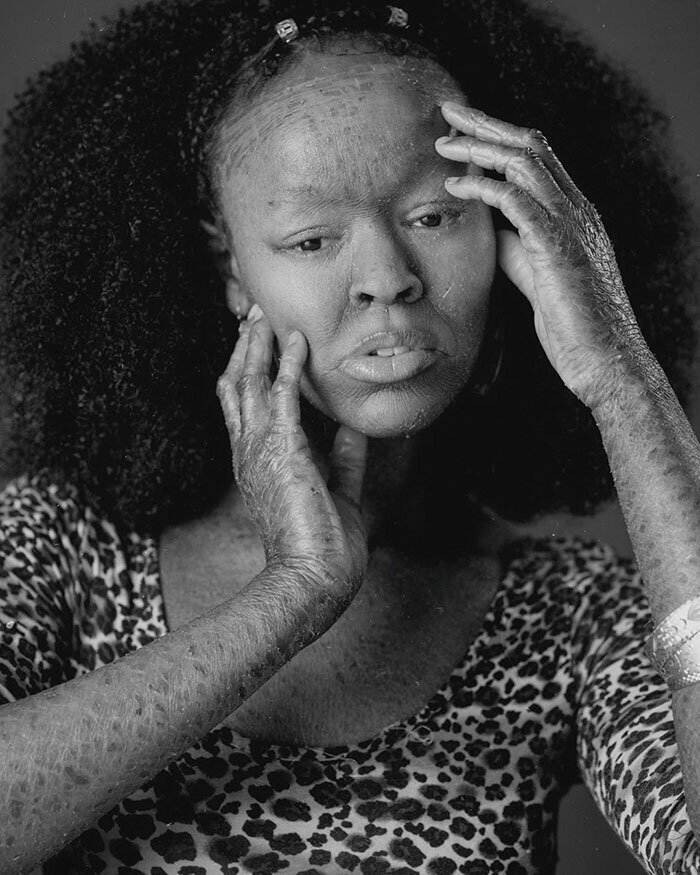 This Woman Never Saw Models With Her Skin Condition, So She Became One