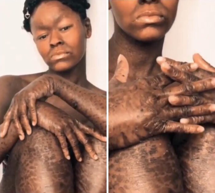 This Woman Never Saw Models With Her Skin Condition, So She Became One