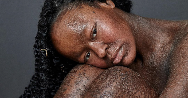 This Woman Never Saw Models With Her Skin Condition, So She Became One