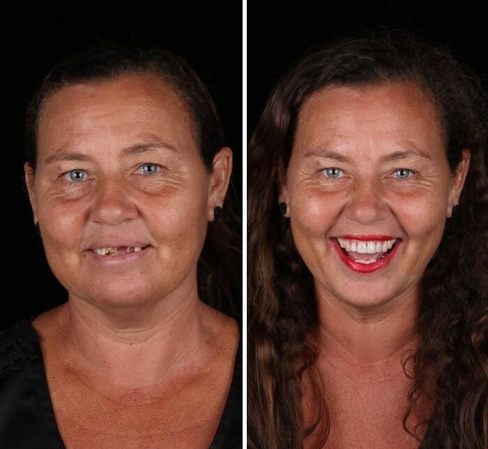 Brazilian Dentist Travels To Treat The Teeth Of Poor People For Free And Here Are 30 Transformations