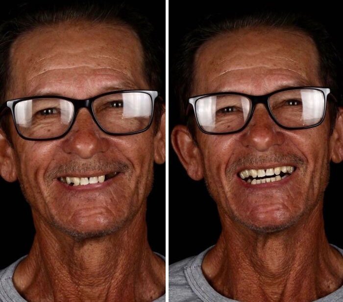 Brazilian Dentist Travels To Treat The Teeth Of Poor People For Free And Here Are 30 Transformations