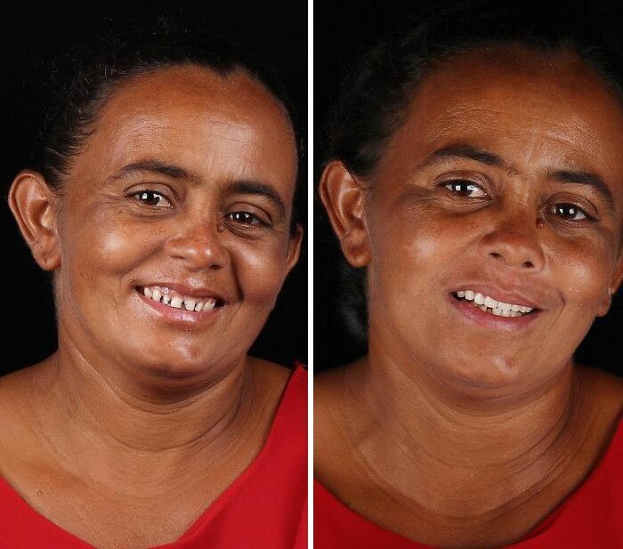 Brazilian Dentist Travels To Treat The Teeth Of Poor People For Free And Here Are 30 Transformations