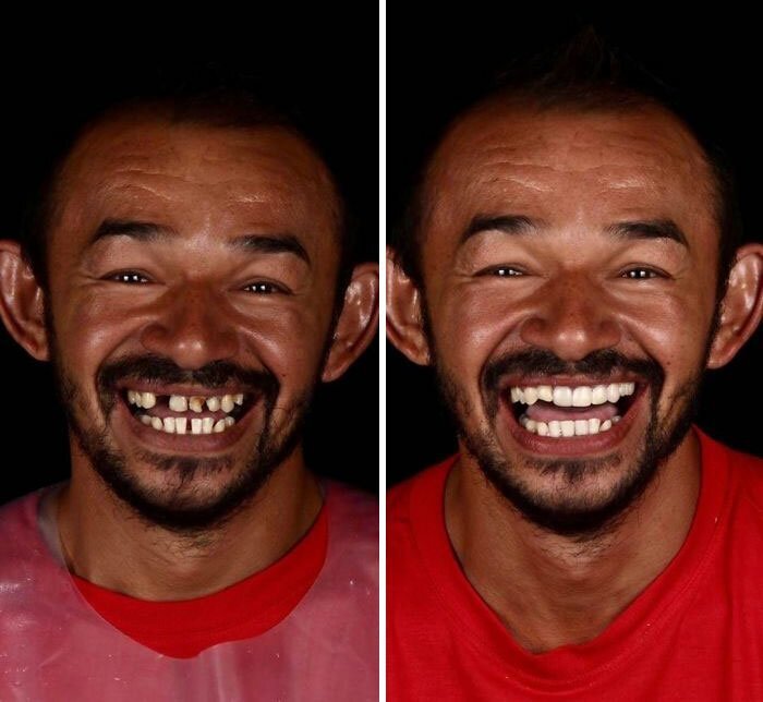 Brazilian Dentist Travels To Treat The Teeth Of Poor People For Free And Here Are 30 Transformations