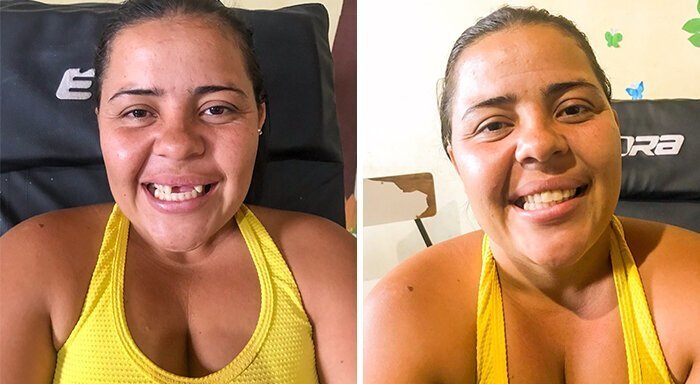 Brazilian Dentist Travels To Treat The Teeth Of Poor People For Free And Here Are 30 Transformations