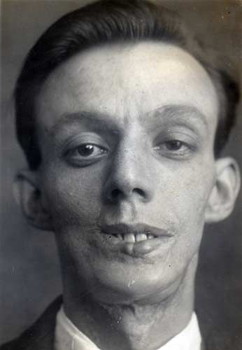 Вилли Викаредж или Вилли Викарий (Willie Vicarage), первый человек который получил полную реконструкцию челюсти 