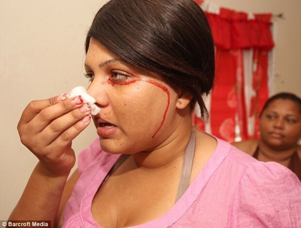 Девушка плачет кровавыми слезами и потеет кровью из-за редкого заболевания