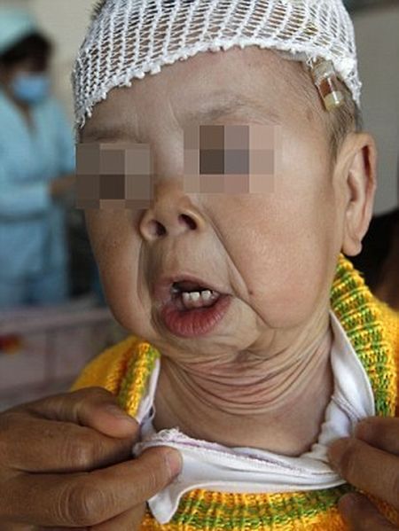 Редчайшее генетическое заболевание китайской малышки
