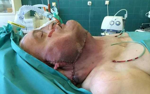 Хирурги срезали с шеи мужчины 6-килограммовый воротник