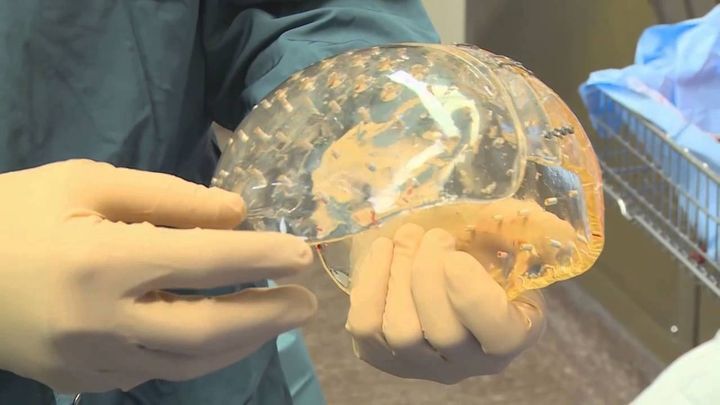 Первая в мире трансплантация черепа 