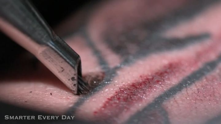 Удаление татуировки лазером 